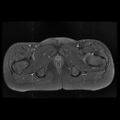 Avascular necrosis of the hip (Radiopaedia 29563-30067 Axial T1 C+ fat sat 14).jpg