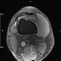 Avulsion fracture of the fibular head (Radiopaedia 74804-85808 Axial PD fat sat 2).jpg
