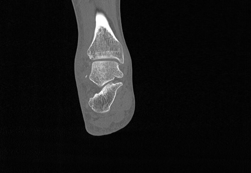 File:Avulsion fractures of talus and calcaneus (Radiopaedia 48277-53155 Coronal bone window 65).jpg
