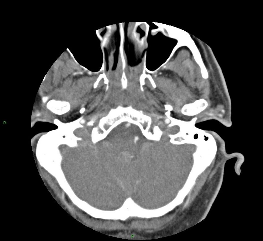 Basal ganglia hemorrhage (Radiopaedia 58763-65985 D 32).jpg