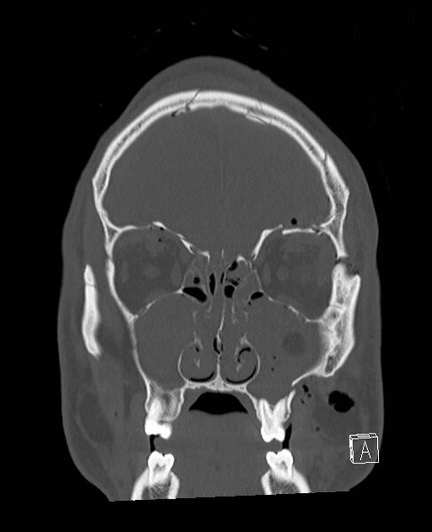 File:Base of skull fracture with bilateral Le Fort fractures (Radiopaedia 47094-51638 Coronal bone window 75).jpg