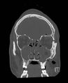 Base of skull fracture with bilateral Le Fort fractures (Radiopaedia 47094-51638 Coronal bone window 75).jpg
