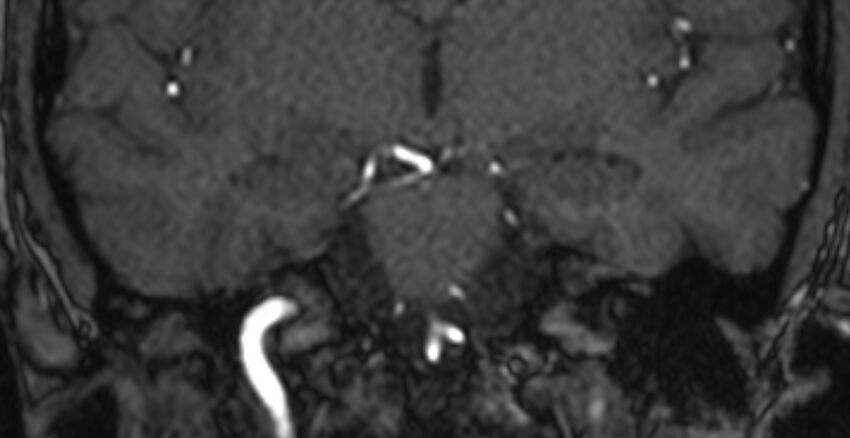 Basilar artery fenestration (Radiopaedia 74537-85455 Coronal MRA TOF 48).jpg