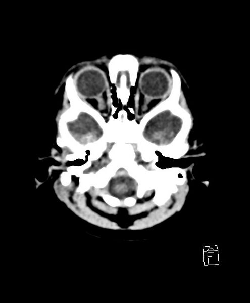 File:Benign enlargement of subarachnoid spaces in infancy (BESS) (Radiopaedia 87459-103795 Axial non-contrast 77).jpg