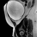 Benign seromucinous cystadenoma of the ovary (Radiopaedia 71065-81300 Sagittal T2 22).jpg