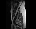 Bicornuate bicollis uterus (Radiopaedia 61626-69616 Sagittal T2 2).jpg