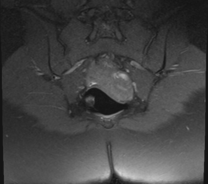 File:Bicornuate uterus (Radiopaedia 71214-81511 Coronal T1 fat sat 5).jpg
