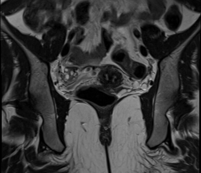 File:Bicornuate uterus (Radiopaedia 71214-81511 Coronal T2 16).jpg