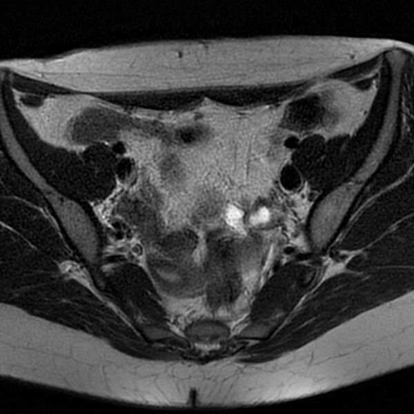 File:Bicornuate uterus (Radiopaedia 72135-82643 Axial T2 7).jpg