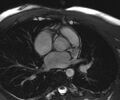 Bicuspid aortic valve with aortic coarctation (Radiopaedia 29895-30410 Oblique SSFP Cine 7).jpg
