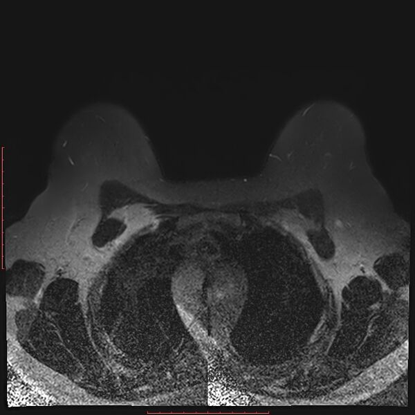 File:Bilateral breast implant rupture (Radiopaedia 24761-25027 T2 fat sat 7).jpg
