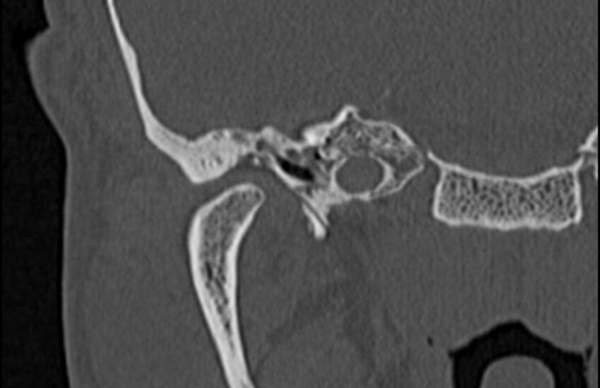 Bilateral cholesteatoma (Radiopaedia 54898-61172 Coronal bone window 16).jpg