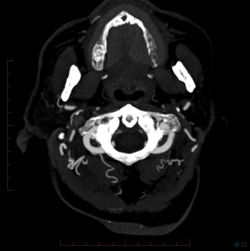 Bilateral chronic common carotid occlusion (Radiopaedia 50849-56362 D 30).jpg