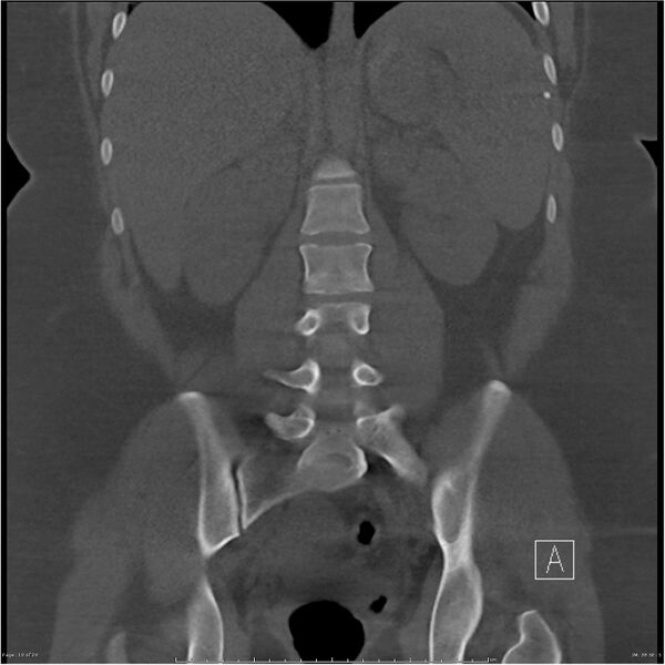 File:Bilateral lumbar ribs (Radiopaedia 25862-26010 Coronal bone window 10).jpg