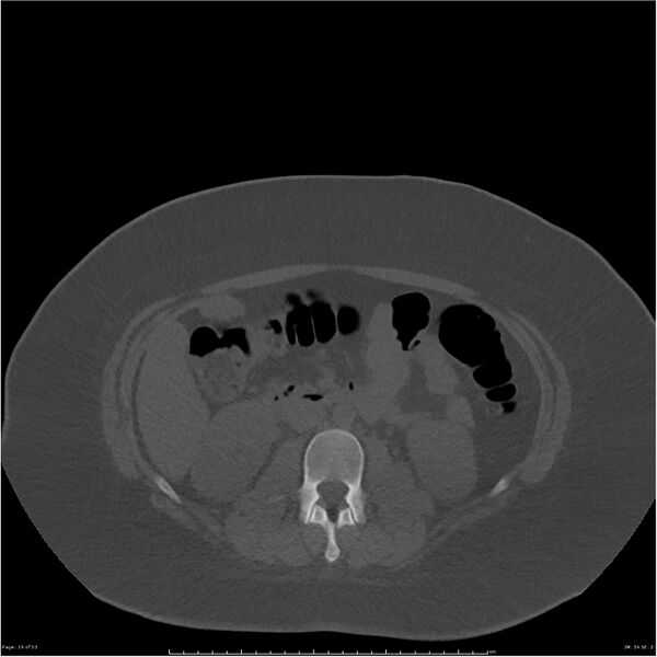 File:Bilateral lumbar ribs (Radiopaedia 25862-26010 bone window 19).jpg
