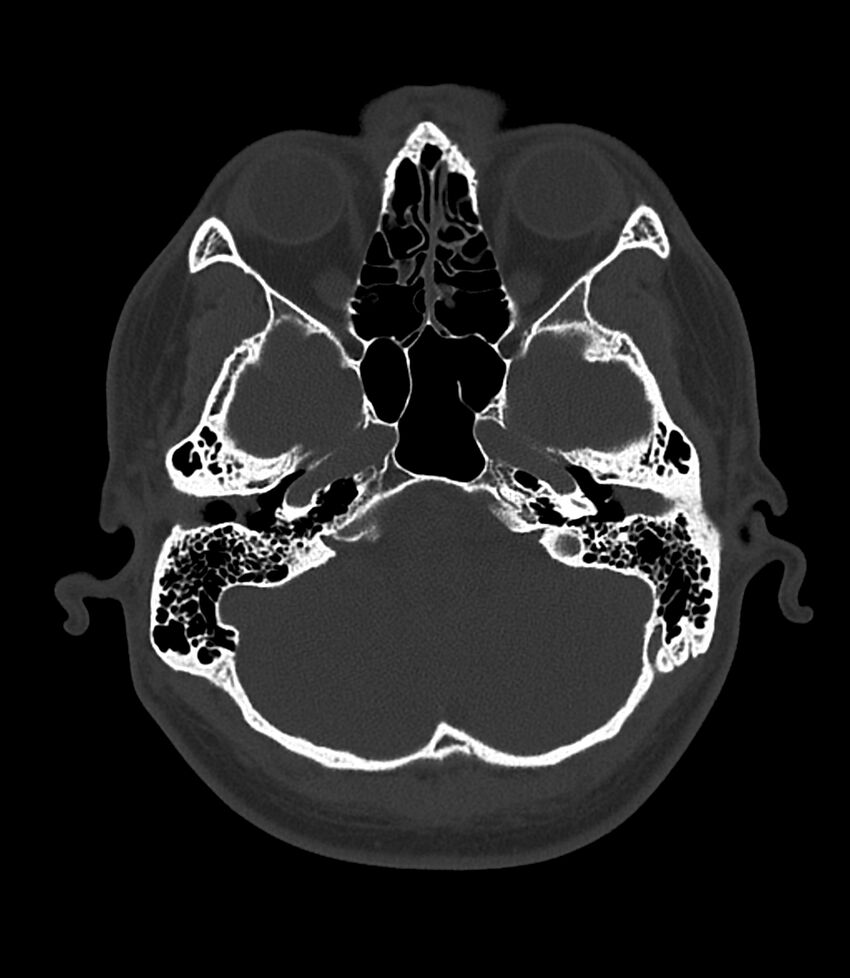 Bilateral medial canal fibrosis (Radiopaedia 85598-101344 Axial bone window 29).jpg