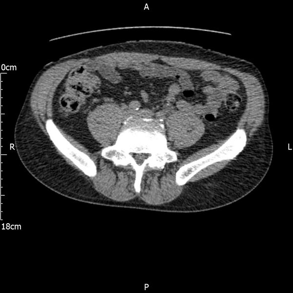 File:Bilateral medullary nephrocalcinosis with ureteric calculi (Radiopaedia 71269-81569 Axial non-contrast 85).jpg