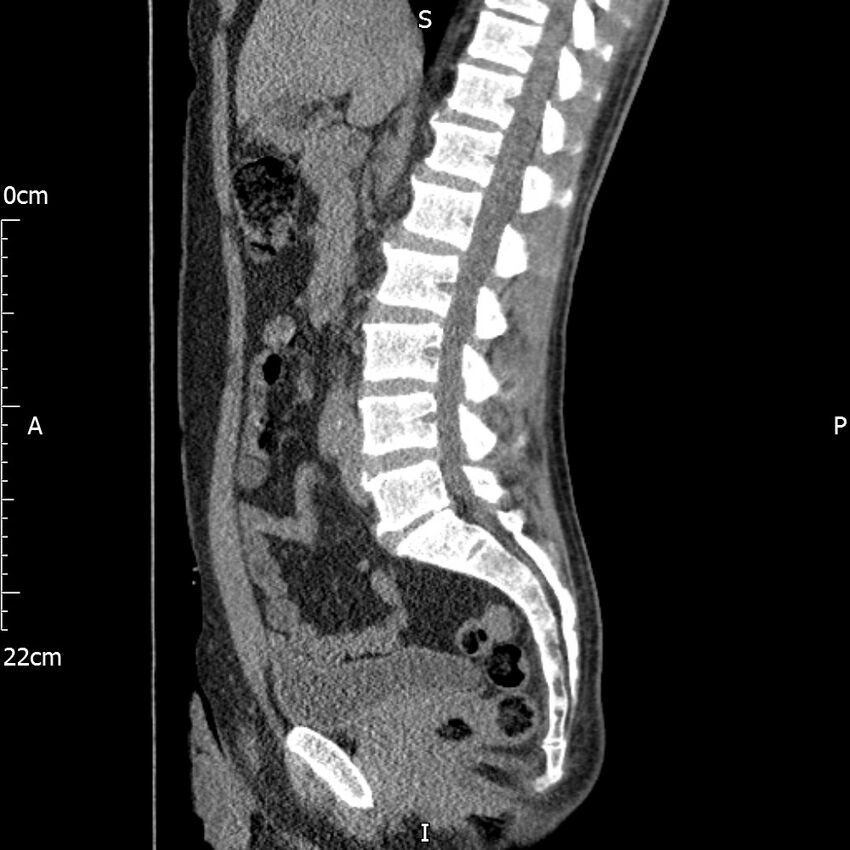 Bilateral medullary nephrocalcinosis with ureteric calculi (Radiopaedia 71269-81569 C 61).jpg