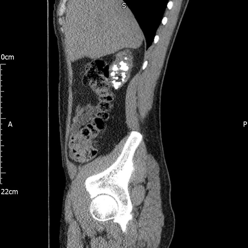 Bilateral medullary nephrocalcinosis with ureteric calculi (Radiopaedia 71269-81569 C 85).jpg