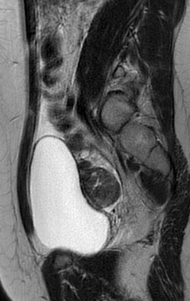 File:Bilateral ovarian fibrothecomas - adolescent (Radiopaedia 86604-102707 Sagittal T2 11).jpg
