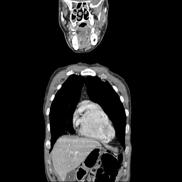 File:Bilateral parotid gland lymphoma (Radiopaedia 21038-20969 B 4).jpg