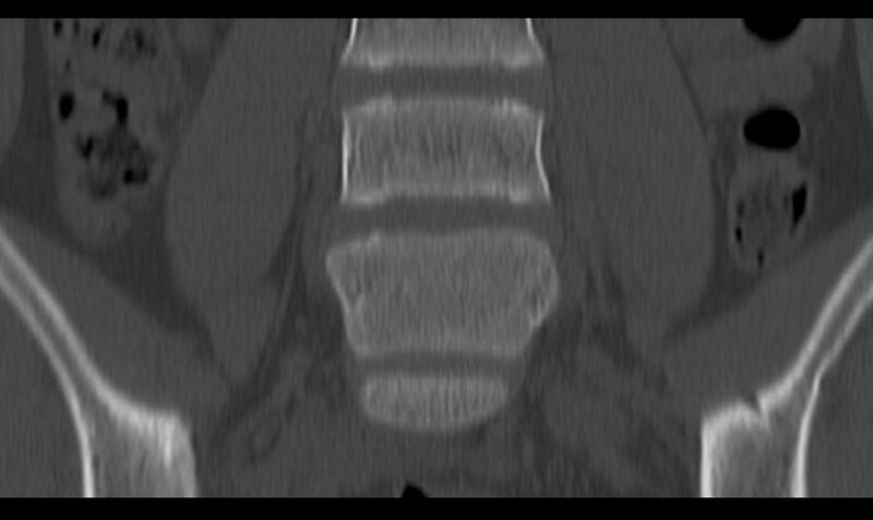 File:Bilateral pars defect (Radiopaedia 26691-26846 Coronal bone window 17).jpg