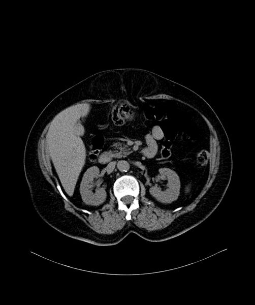 File:Bilateral sporadic synchronous clear cell renal cell carcinoma (Radiopaedia 85035-100572 Axial non-contrast 27).jpg