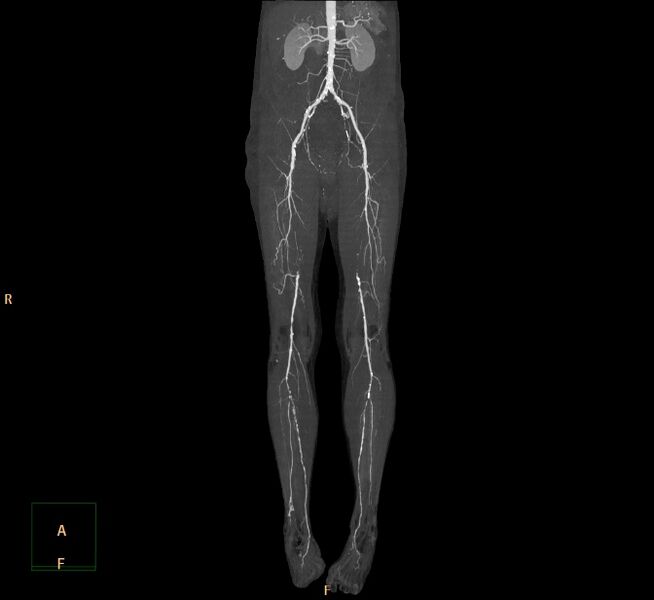 File:Bilateral superficial femoral arterial occlusion (Radiopaedia 25682-25857 3D MIP 1).jpg