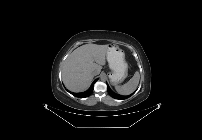 File:Bilateral urolithiasis with incidentally detected splenic artery aneurysm and left inferior vena cava (Radiopaedia 44467-48123 Axial non-contrast 6).jpg