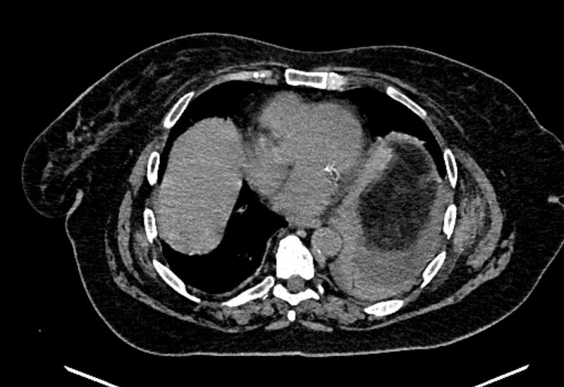 File:Biliary pancreatitis (Radiopaedia 72289-82823 Axial non-contrast 18).jpg