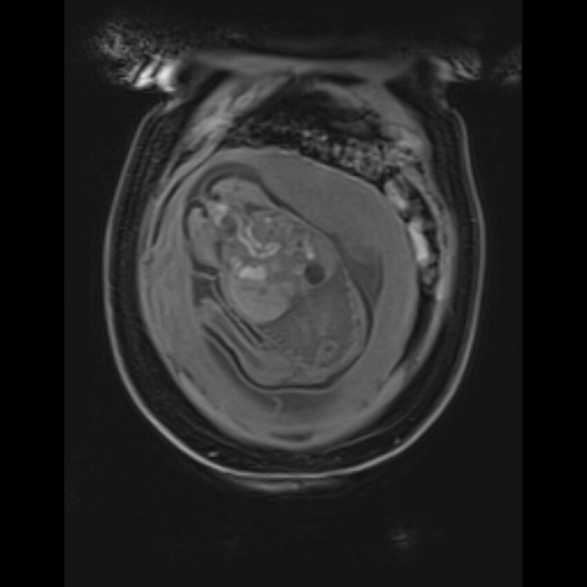 Bilobed placenta accreta (Radiopaedia 69648-79591 Coronal T1 vibe 36).jpg