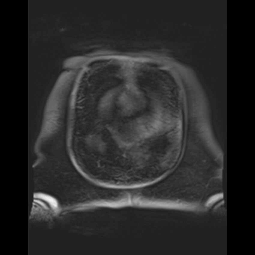 Bilobed placenta accreta (Radiopaedia 69648-79591 Coronal T1 vibe 5).jpg