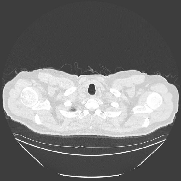 File:Birt-Hogg-Dubé syndrome (Radiopaedia 52578-58491 Axial lung window 1).jpg