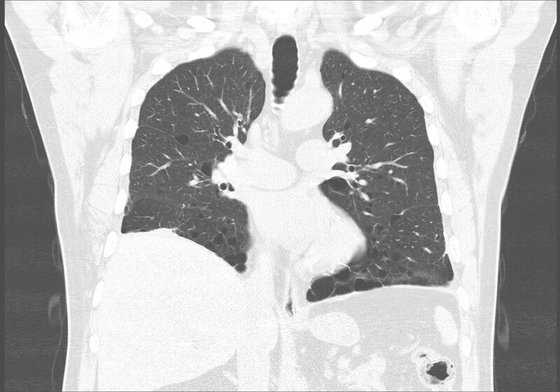 File:Birt-Hogg-Dubé syndrome (Radiopaedia 52578-58491 Coronal lung window 27).jpg