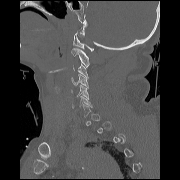 File:Blunt cerebrovascular injury (Radiopaedia 53682-59743 Sagittal bone window 5).png