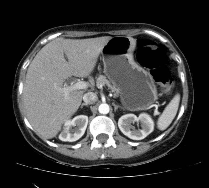 File:Bosniak renal cyst - type IV (Radiopaedia 22929-22953 B 26).jpg