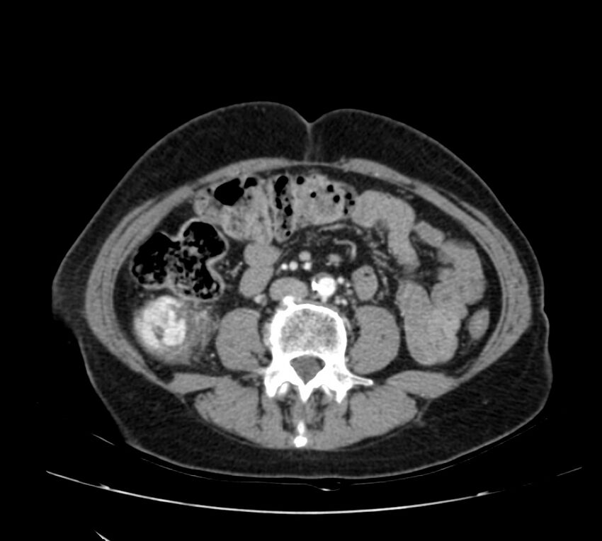 Bosniak renal cyst - type IV (Radiopaedia 22929-22953 B 63).jpg