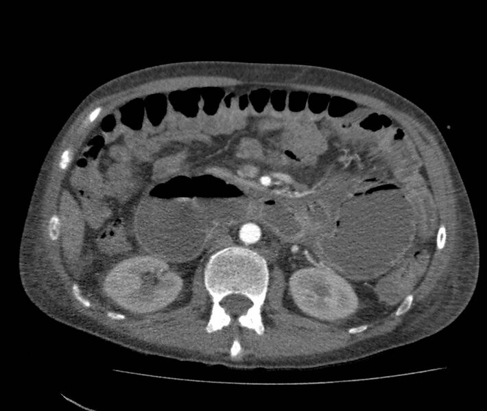 File:Bowel lymphoma complicated by bleeding after therapy (Radiopaedia 55601-62110 B 34).jpg