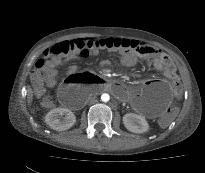 File:Bowel lymphoma complicated by bleeding after therapy (Radiopaedia 55601-62110 B 35).jpg
