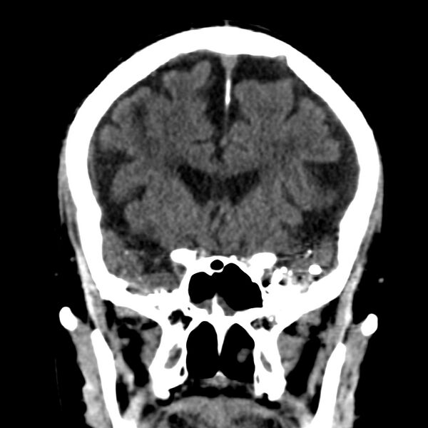 File:Brain Pantopaque remnants (Radiopaedia 78403-91048 Coronal non-contrast 26).jpg