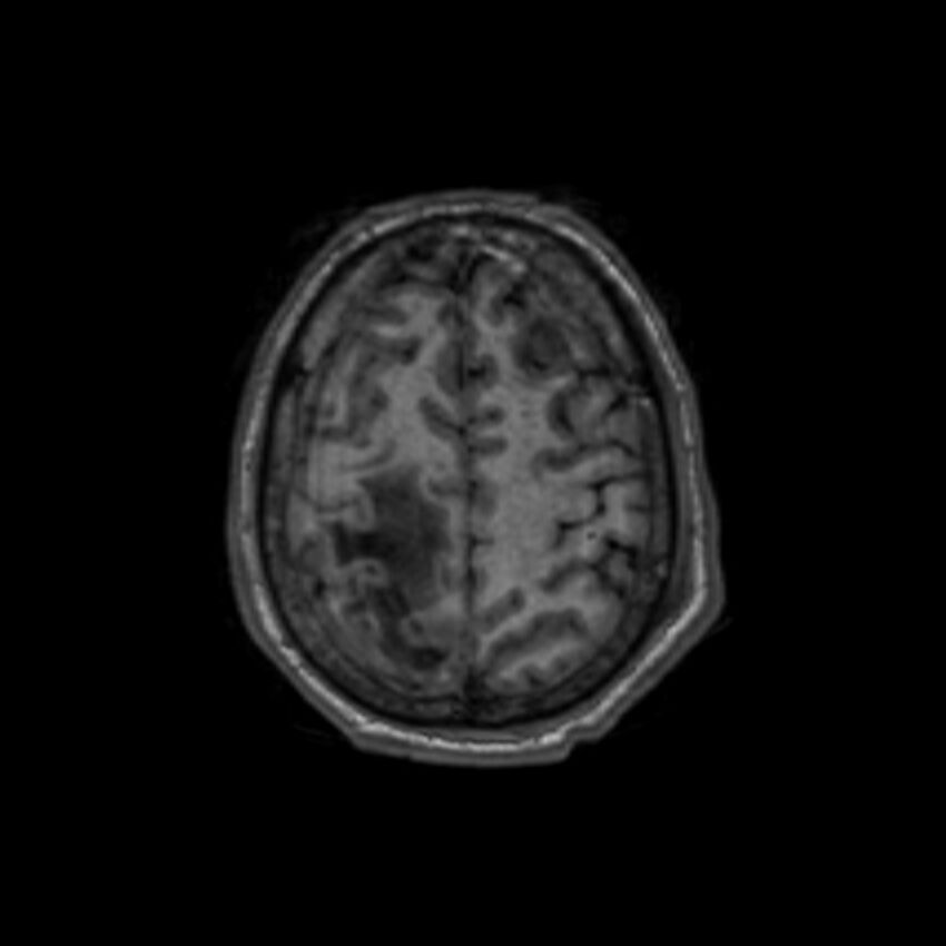 Brain abscess complicated by intraventricular rupture and ventriculitis (Radiopaedia 82434-96577 Axial T1 59).jpg