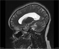 Brainstem glioma (Radiopaedia 21819-21775 Sagittal T2 18).jpg