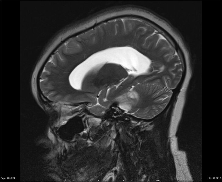File:Brainstem glioma (Radiopaedia 21819-21775 Sagittal T2 18).jpg
