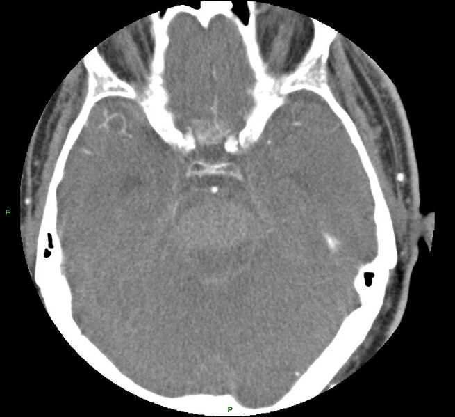File:Brainstem hemorrhage (Radiopaedia 58794-66028 D 68).jpg