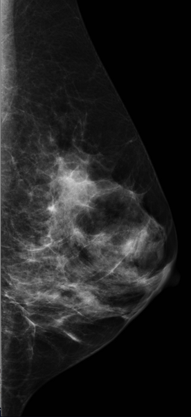 File:Breast hamartoma (Radiopaedia 23800-23942 MLO 1).png