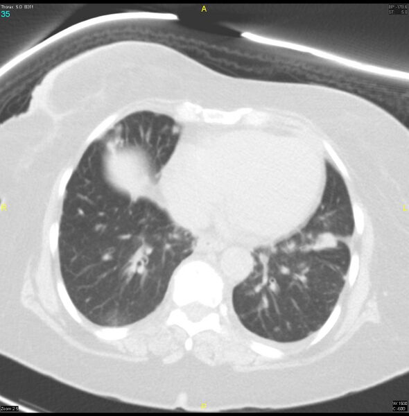 File:Breast primary with lung and bone metastases (Radiopaedia 40620-43228 Axial lung window 35).jpg