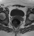 Broad ligament leiomyoma (Radiopaedia 81634-95516 Axial T1 19).jpg