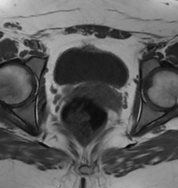 File:Broad ligament leiomyoma (Radiopaedia 81634-95516 Axial T1 19).jpg