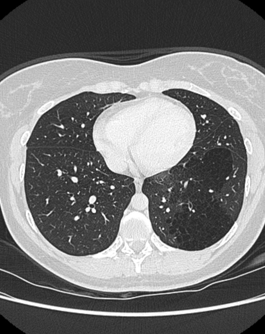 Bronchial atresia (Radiopaedia 50007-55297 Axial lung window 74).jpg