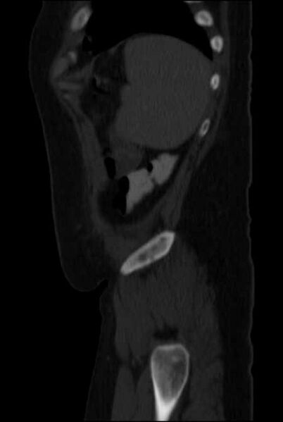File:Brown tumors compressing the spinal cord (Radiopaedia 68442-77988 H 49).jpg